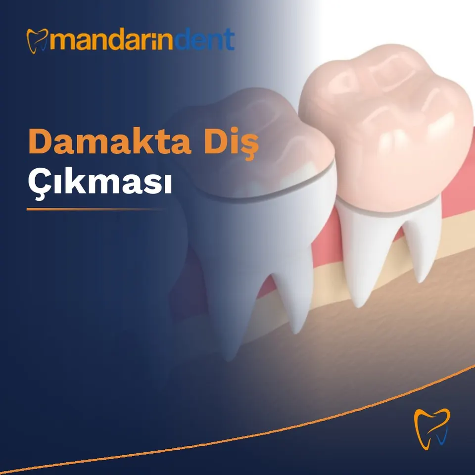 Damakta Diş Çıkması