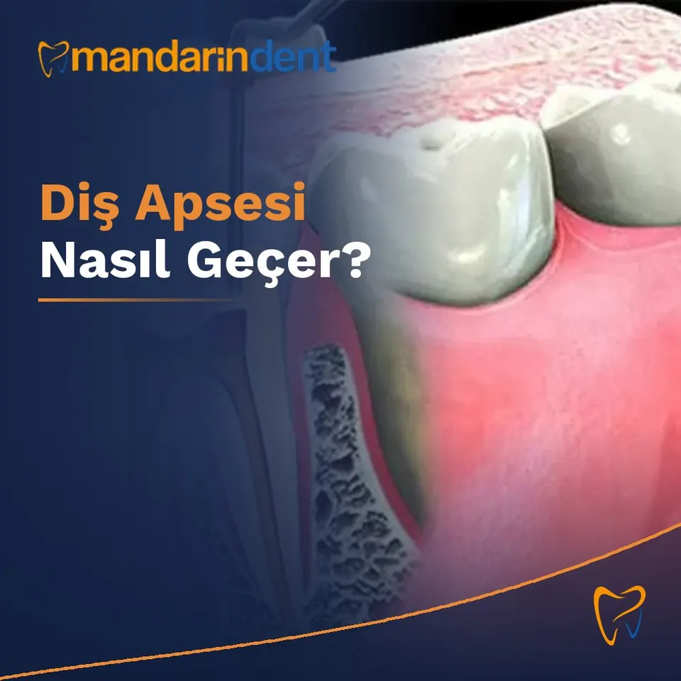Diş Apsesi Nasıl Geçer? | Belirtiler, Acil Eşik ve Hekim Değerlendirmesi