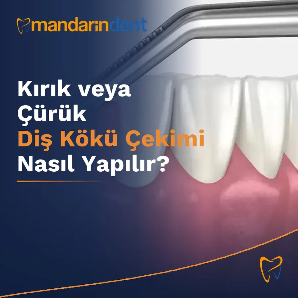 Kırık veya Çürük Diş Kökü Çekimi Nasıl Yapılır?