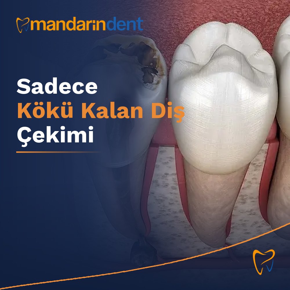 Sadece Kökü Kalan Diş Çekimi