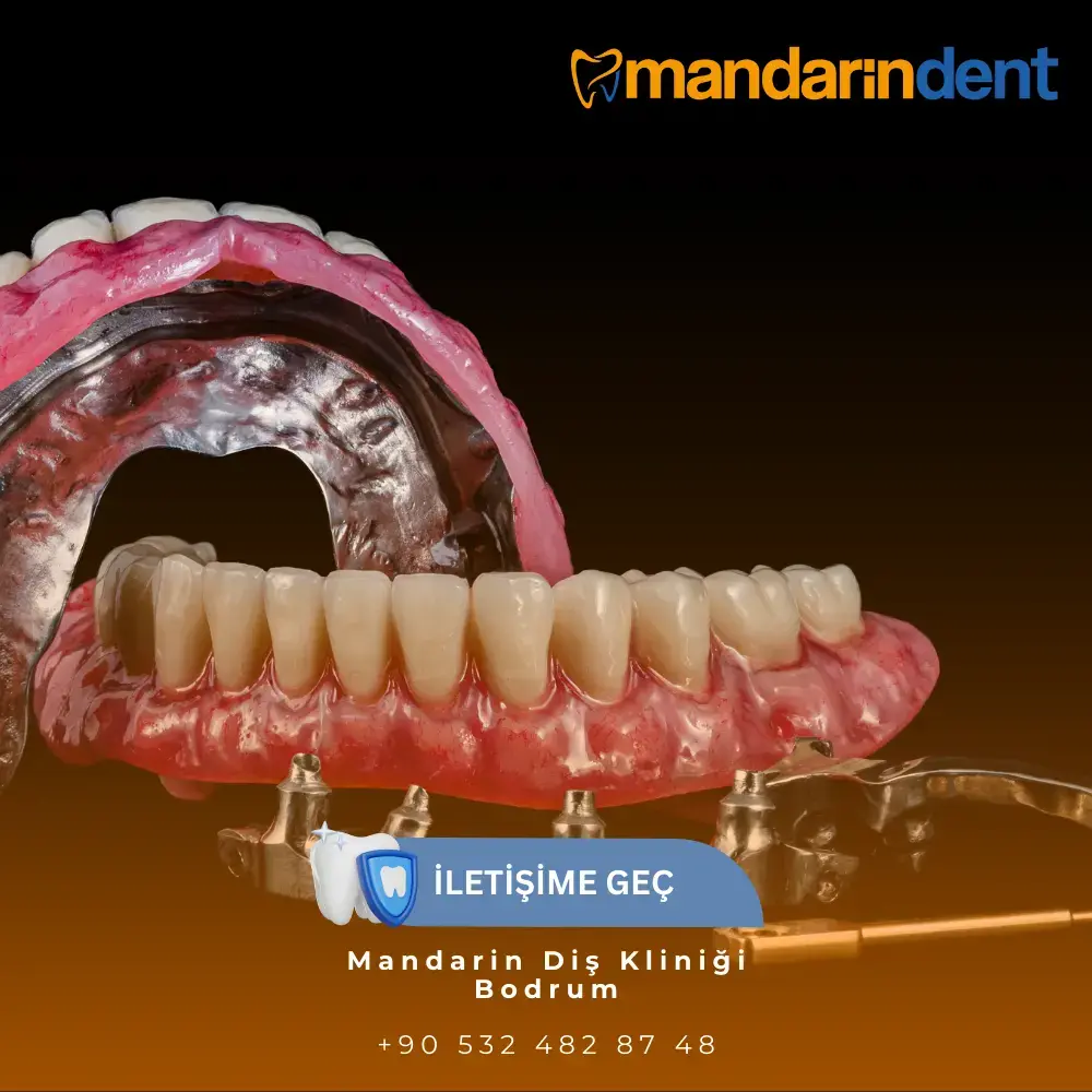 Bodrum All on Six Diş İmplantı Tekniği, Bodrum En İyi İmplant Dİş Kliniği