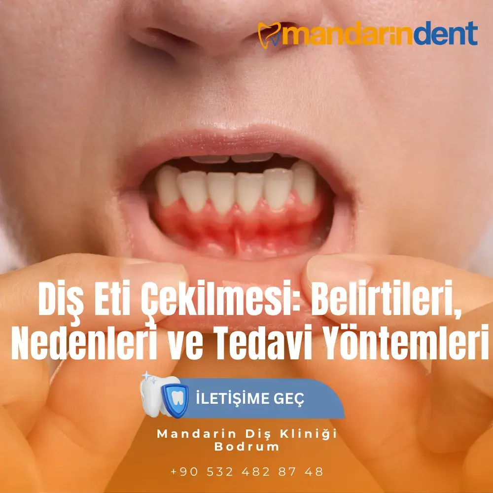 Diş Eti Çekilmesi: Belirtileri, Nedenleri ve Tedavi Yöntemleri