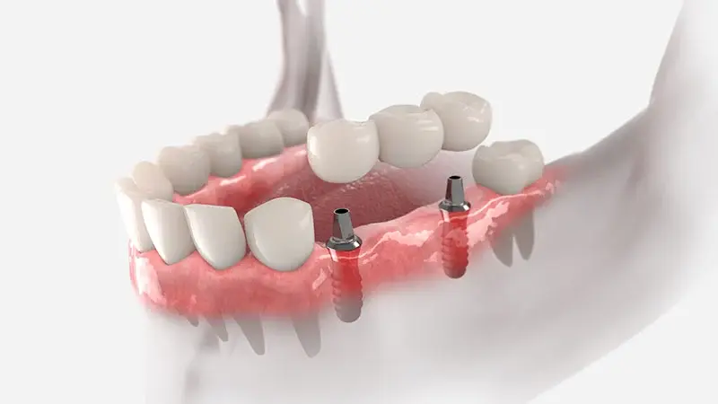 bodrum implant üstü protez