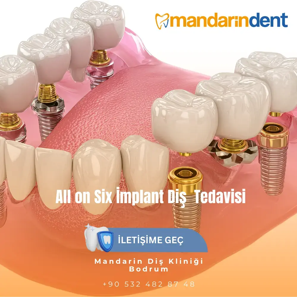 Bodrum All on Six İmplant Diş Tedavisi