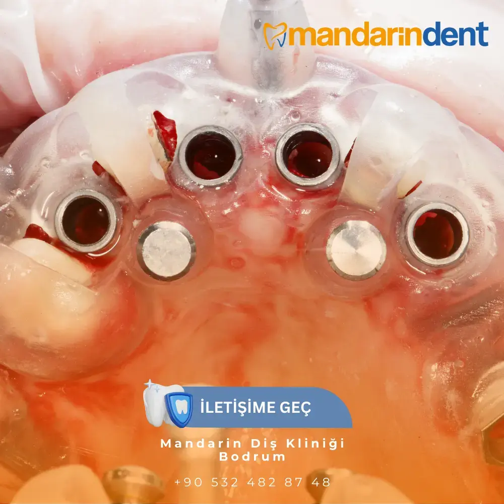 Bodrum All on Six Diş İmplantı Tedavisi, Bodrum En İyi İmplant İş Kliniği