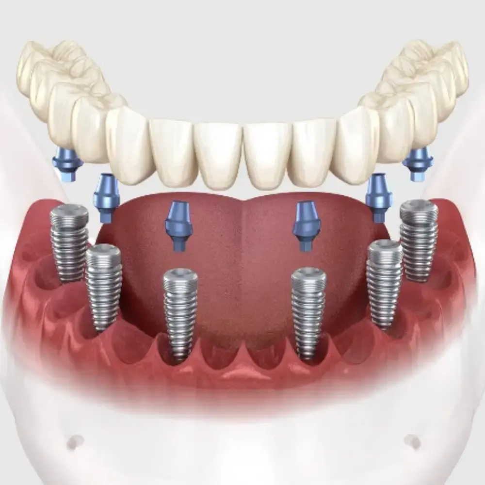 bodrum tam ağız implant