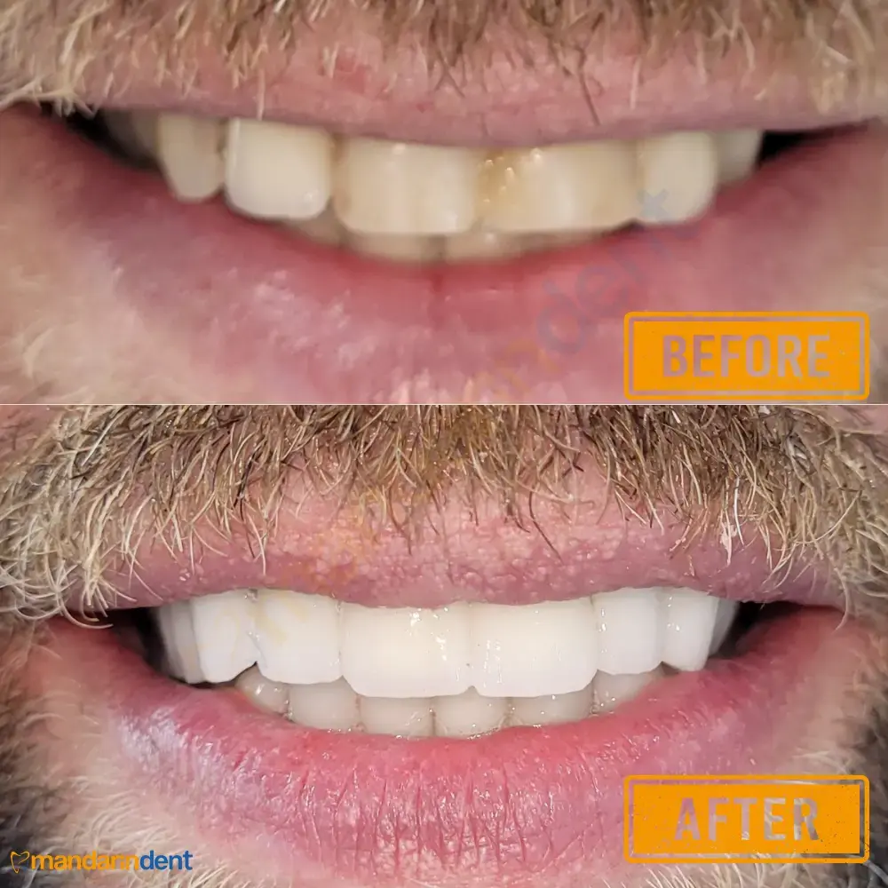 Smile Design bei MandarinDent Bodrum — oben das Vorher-Foto, darunter das Ergebnis