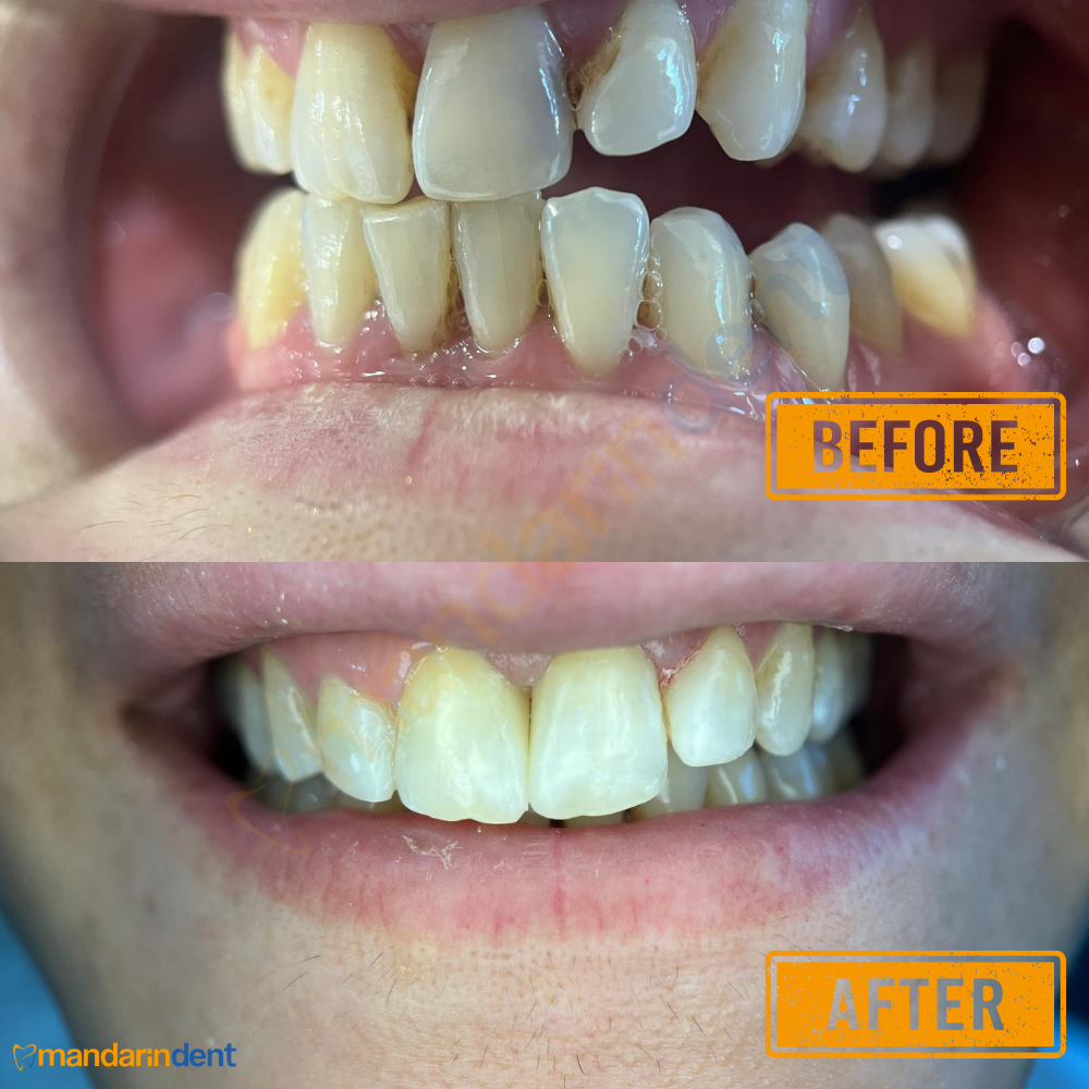 Composite Bonding bei MandarinDent Bodrum — oben das Vorher-Foto, darunter das Ergebnis